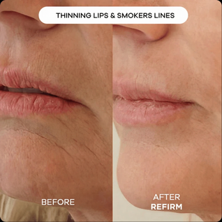 Refirm® Calcium Balm