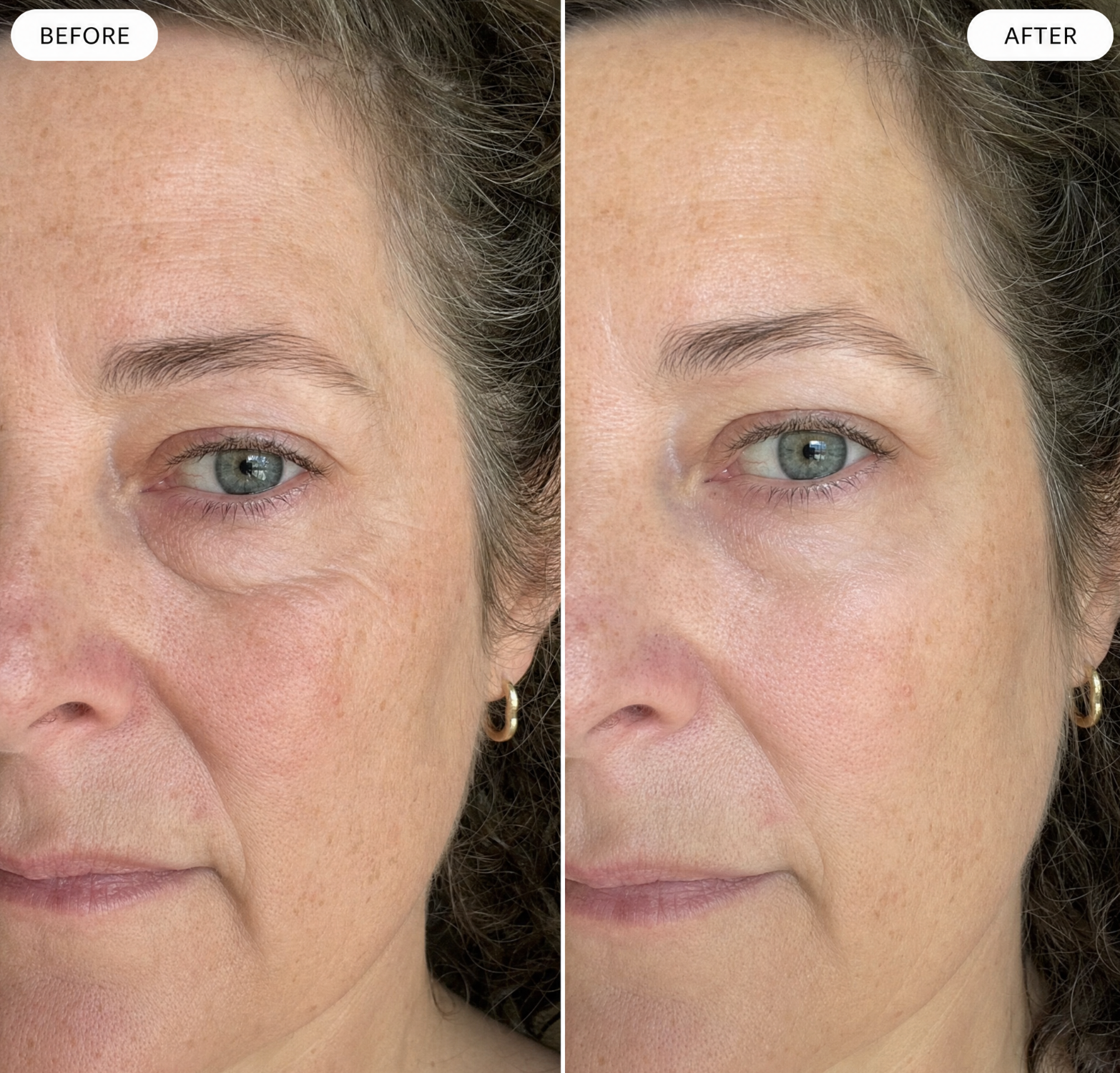 Under eye before and after