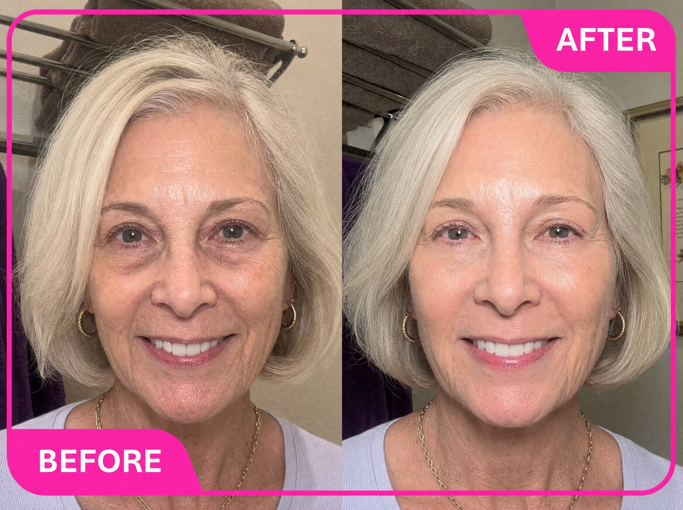 Close-up before and after showing undereye improvement